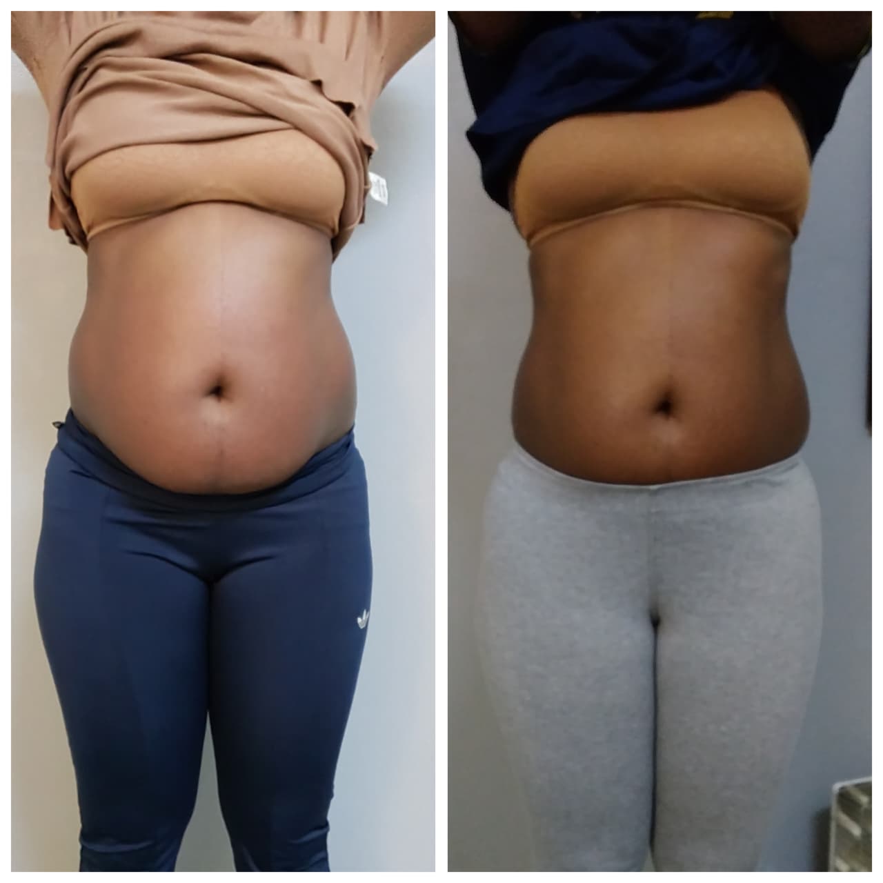 Before and after photo collage of body contouring results