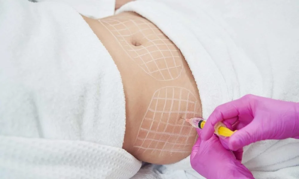 Close-up of lipo injection preparation in a treatment room